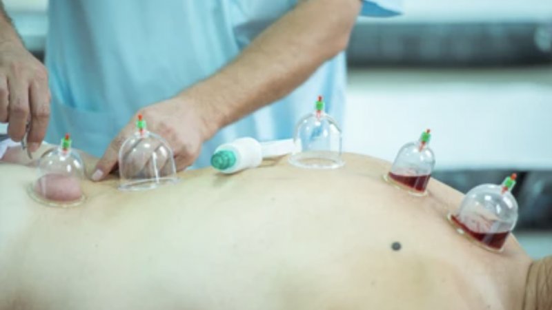 How not to do Hijama